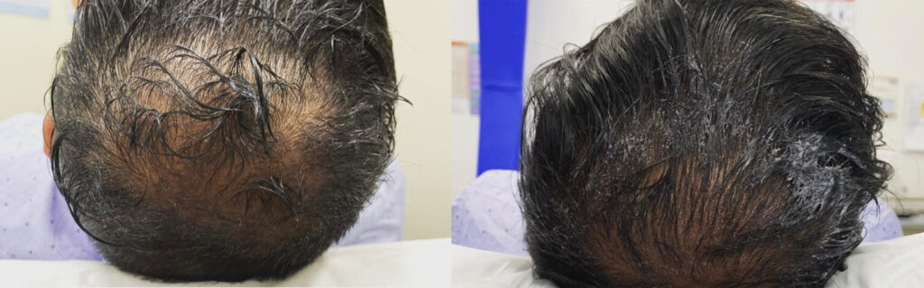 PRP Hair Rejuvenation