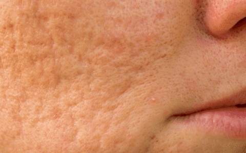 Understanding Acne Scarring and how to treat it