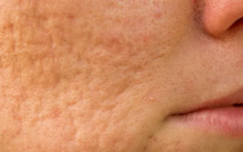 Understanding Acne Scarring and how to treat it