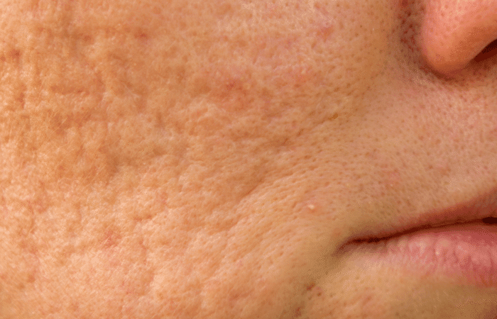 Understanding Acne Scarring and how to treat it