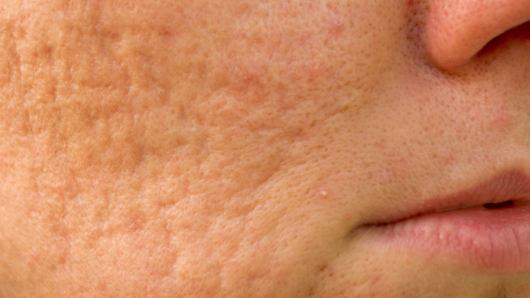 Understanding Acne Scarring and how to treat it