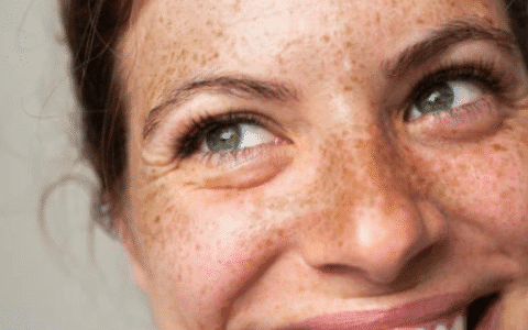 How to treat hyperpigmentation in South Australia
