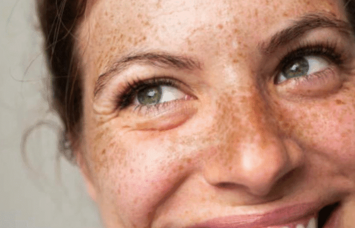 How to treat hyperpigmentation in South Australia