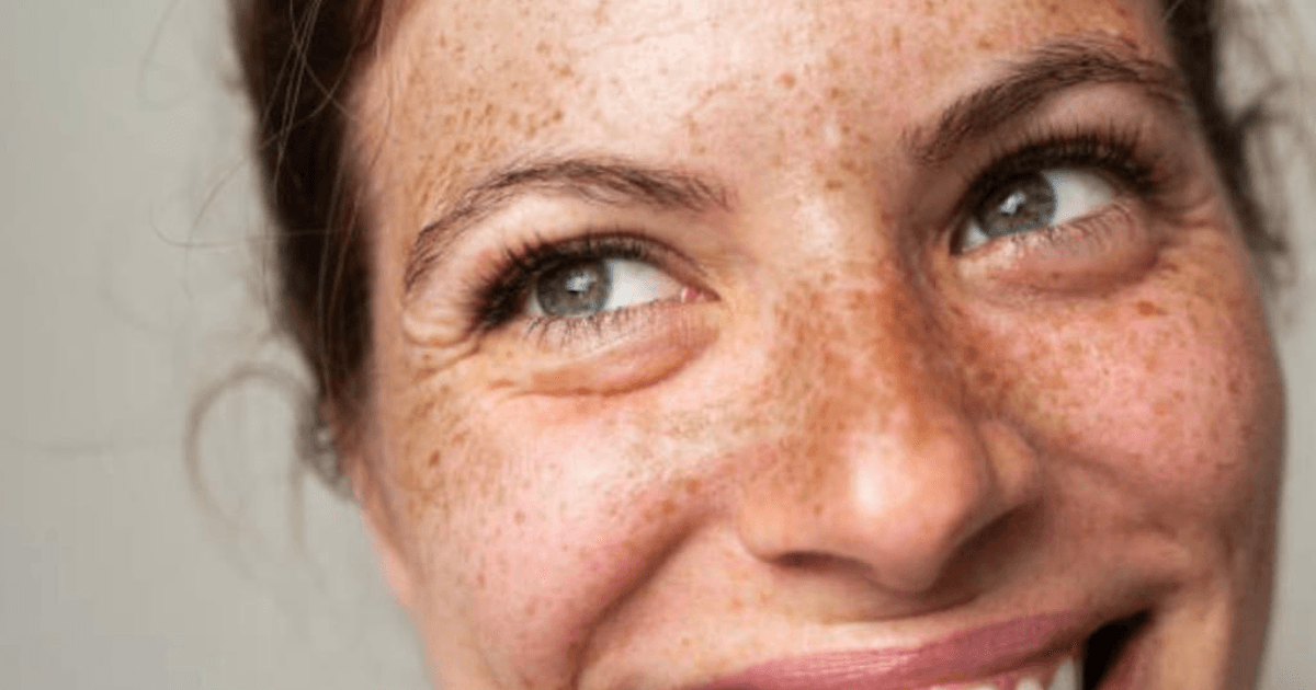 How to treat hyperpigmentation in South Australia