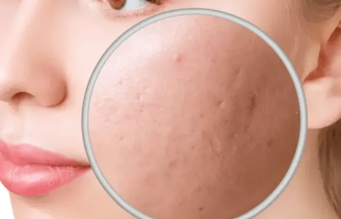 How to Reduce Acne Scars in 2026