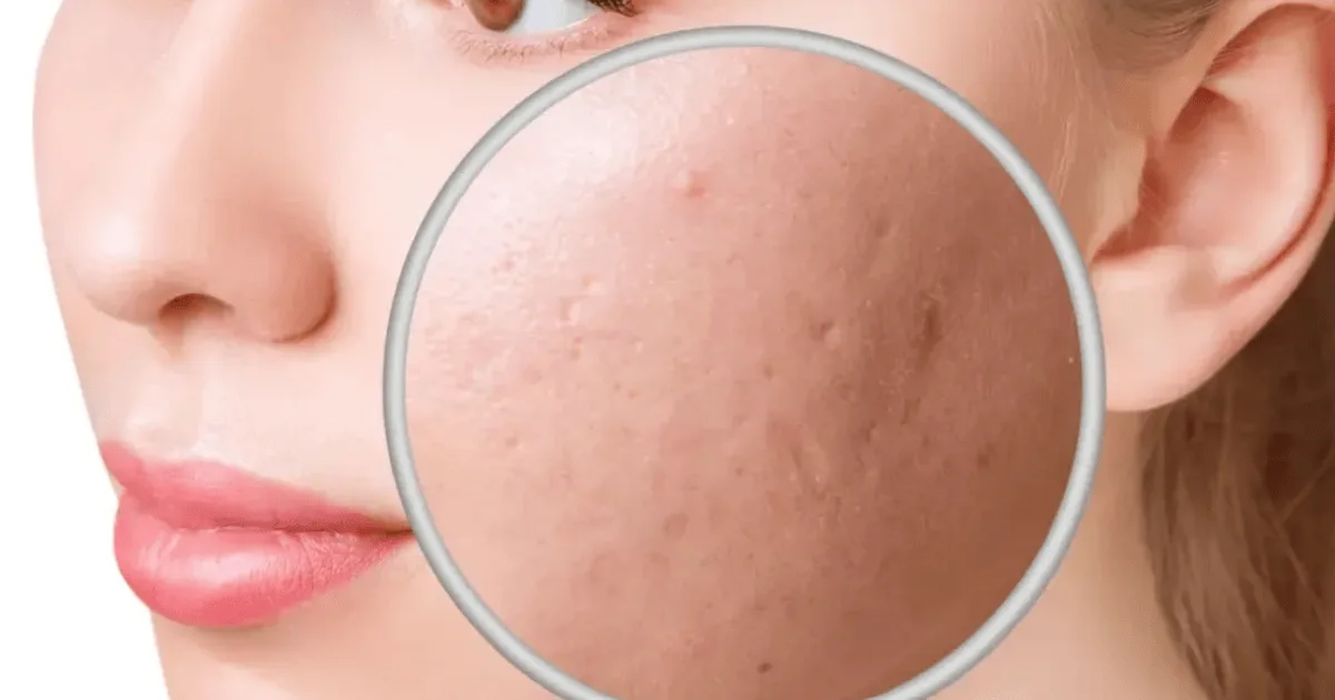How to Reduce Acne Scars in 2026