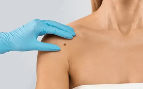 How to remove skin tags in 2026