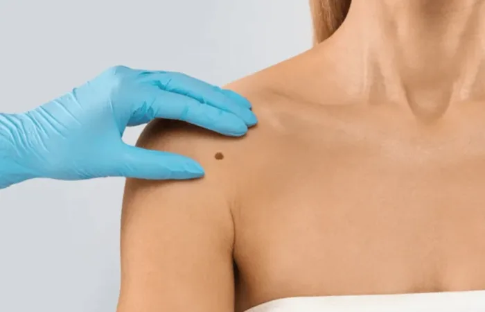 How to remove skin tags in 2026