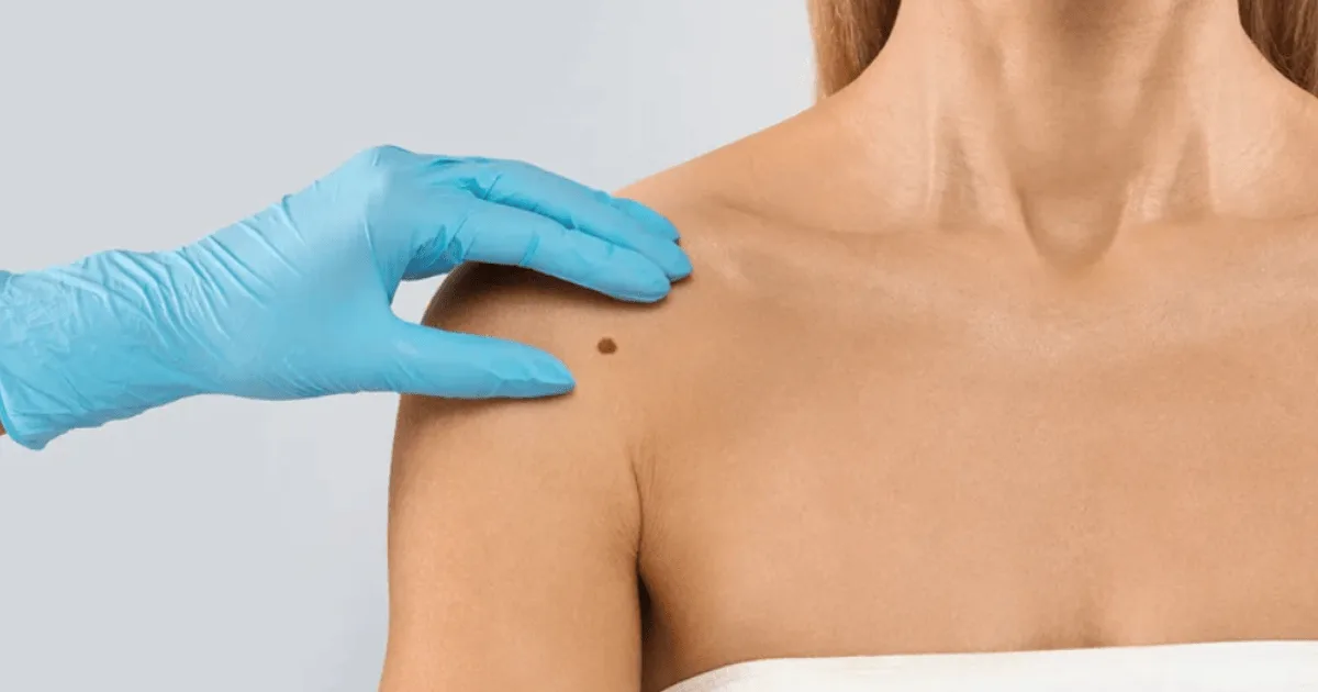 How to remove skin tags in 2026