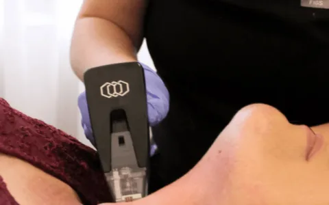 Morpheus8 Treatment in Australia