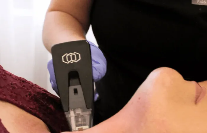 Morpheus8 Treatment in Australia